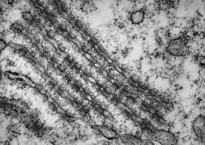M,21y. | annulate lamellae - intracranial germinoma M,21y. | annulate lamellae - intracranial germinoma